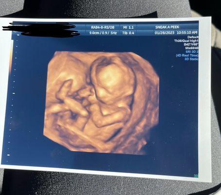 Sneak-A-Peek 3D/4D Ultrasound