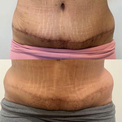 Micro-channeling. Improve all types of scarring