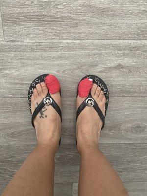 After removal ( Credit Another podiatrist)