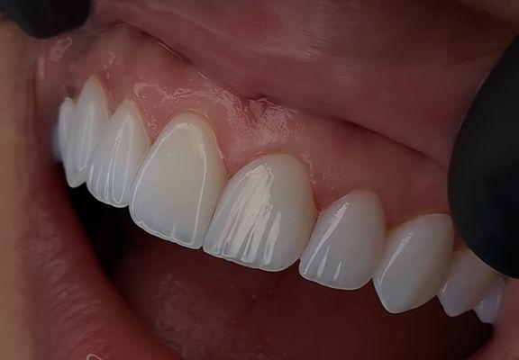 Emax veneers