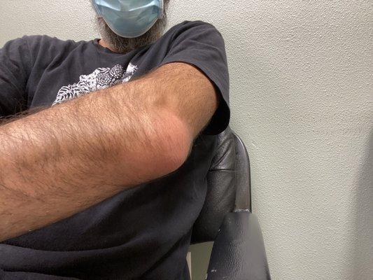 Swollen, infected bursa.