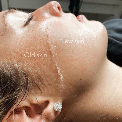Fuss removal with full Facial