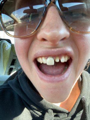 Crown fell out and they don't even look natural!