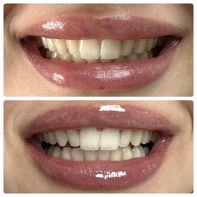 A refreshed, younger looking smile