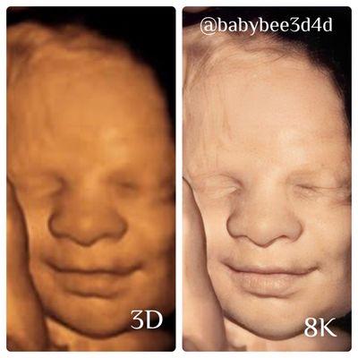 Baby Bee 3D Ultrasound