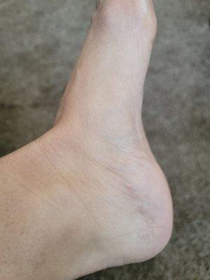 InDepth Laser Therapy