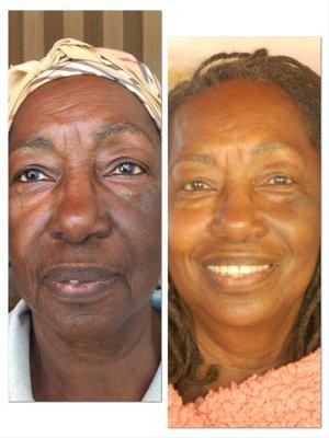 After 10 Acupuncture Facial Rejuvenation Treatments