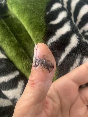 This is after stitches removed