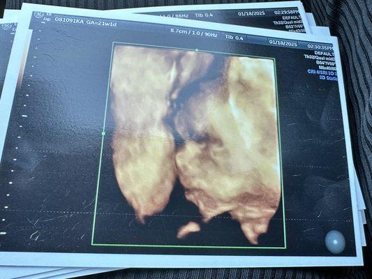 Mommy and Me 3D 4D Ultrasound