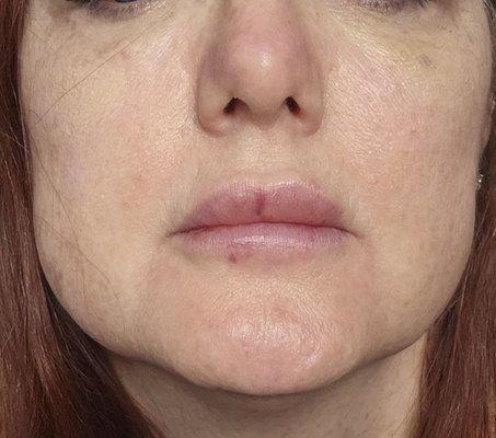 This is after the dissolving. You can see that it still has not gone down.