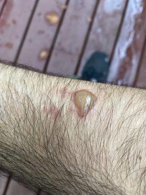 It's bigger the next day and hurts