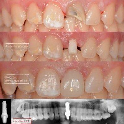 The central incisor was in bad condition. The patient didn't want metal titanium implant. We're able to do this with no trauma to the gum.
