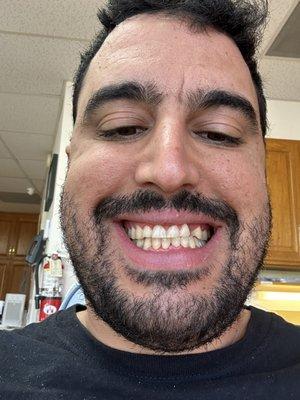 At the ORTHODONTIST office. Got my braces off.