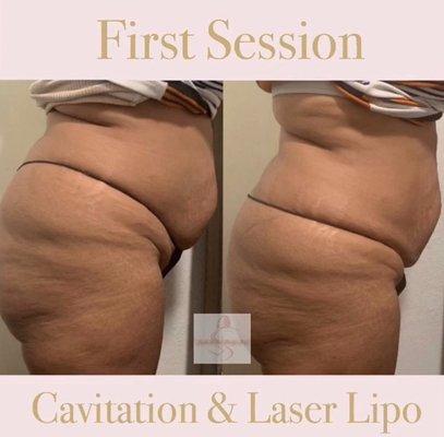 First Tummy Session of Cavitation and Laser Lipo