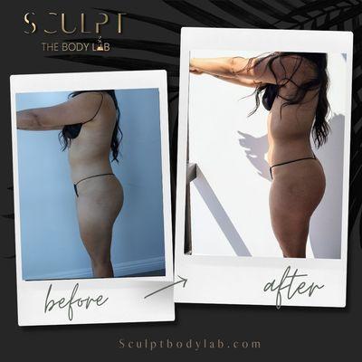 Non Invasive body sculpting