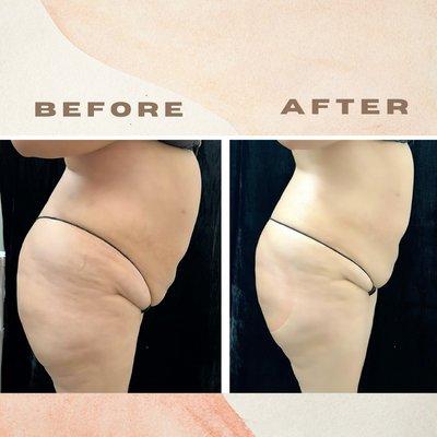 Cavitation, RF Skin Tightening, RF Vacuum and Wood Therapy‼‼
And Vacuum Butt Lift with Cupping therapy and wood therapy