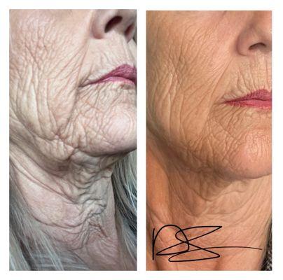 Face By Clinical Edge Non-invasive Facelift