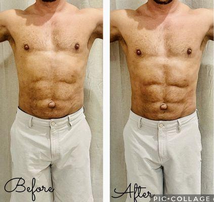 Post-op lymphatic drainage treatment. Taken immediately after only a single session.