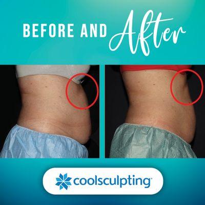 Bodenvy CoolSculpting & Weight Loss Tulsa