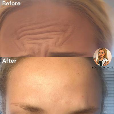 Smooth, natural, and refreshed
Forehead lines don't stand a chance with our wrinkle relaxer treatments at The Boujee Blonde Aesthetics