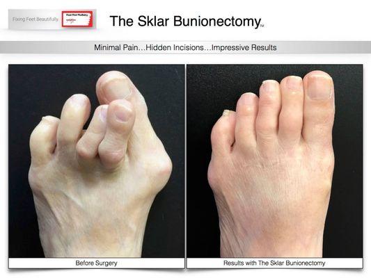 Get a facelift for your feet with our unique bunion procedure, the Sklar Bunionectomy. Visit www.footfirst.com for more info.