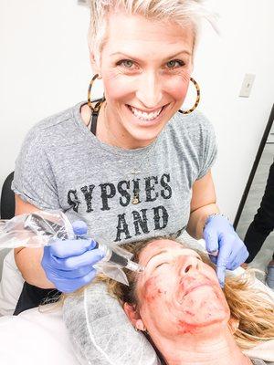 Microneedling facial treatment - with good pinpoint bleeding (what we want for great results; petechiae noted and healed within a day)