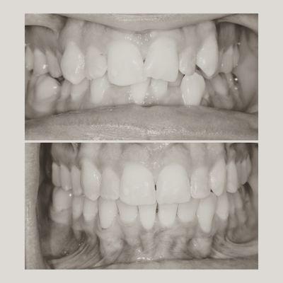 My before and after invisalign