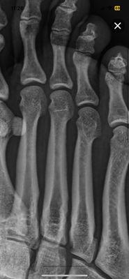 Third toe, white opaque line-- matching the 30gau insulin syringe tip.