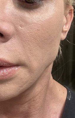 Punch biopsy scar next to nose. It should've been sutured