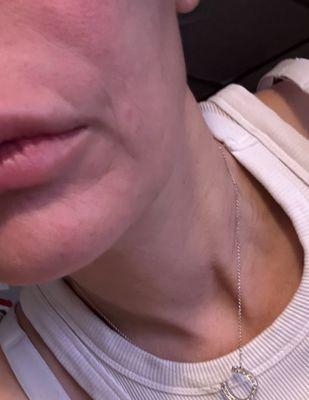4 years later after filler in my smile lines the dent in my LIP is still there please don't don't call me again to take remove post