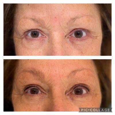 Upper eyeliner healed