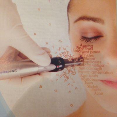 Microneedle treatment