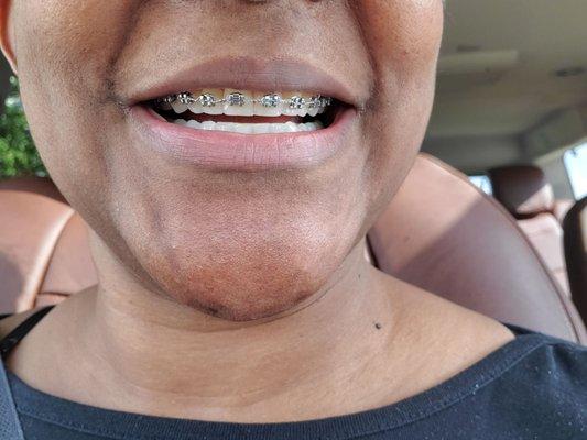 Nine months after braces and my smile is gaining attention followed by compliments.