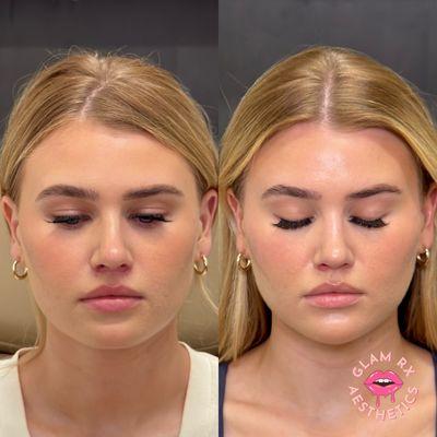 Millennial Makeover: cheek contour with filler, chin pop with filler, chin and lip flip Botox (Provider: Shelby Cooper)