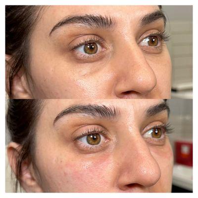 EZ PRF GEL, helps with the texture, volume loss and dark under eyes. This is all natural.