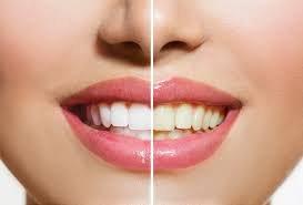 Guaranteed 2-8 Shades Whiter in 15 Minutes