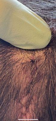 The sutures/stitches that were missed.