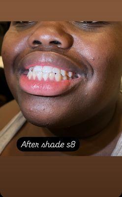 Teeth whitening after photo