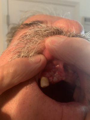 Butcher of a dentist and wont see my husband for a follow up! All infected