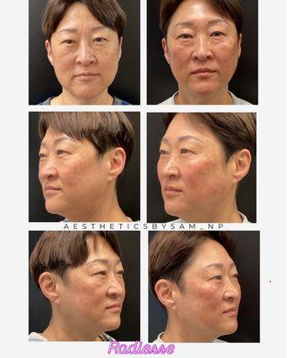 Radiesse bio stimulating fillers to revolumize the face instantly while looking natural.