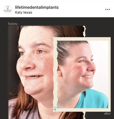 Your dream smile is possible! See the difference expert hands can make!#smilemakeover#katy#dentist