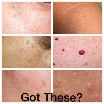 We can help! Our skin classic treatment uses high frequency to essentially dehydrate minor skin irregularities.
