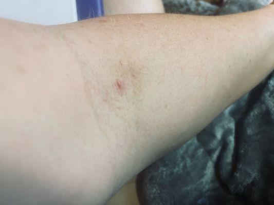 Bruise and needle mark!