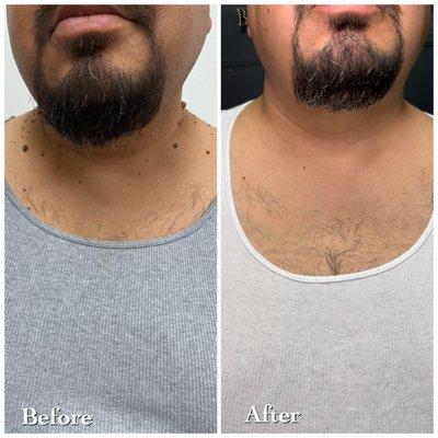 Skin Tag Removal, Mole Removal