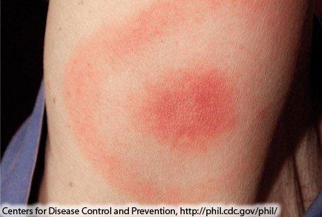 Classid Bulls Eye rash from a Lyme Infected tick