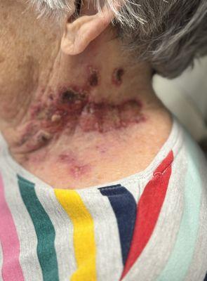 This inflammation and scabbing was called "normal" by Dr Neyman.