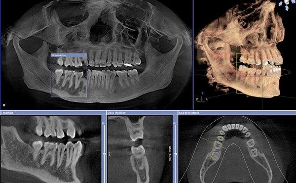 By using the latest 3D CBCT images we are able to make dental diagnoses that 2d X-rays sometimes miss.