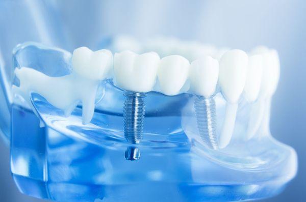 Ask about our implant specials.