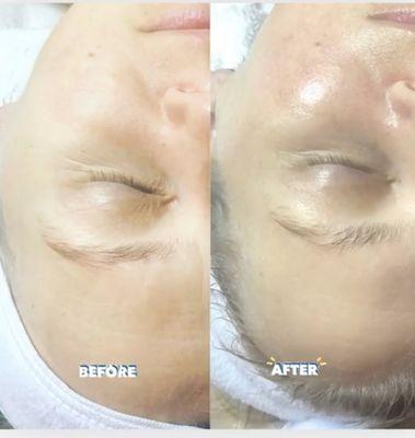 "Anti-aging facial in Brookhaven ."