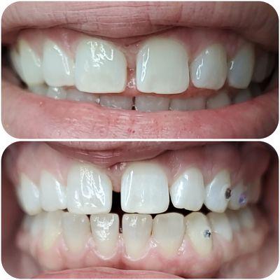Before & After tooth gem placement